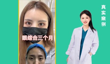 眼综合3个月效果