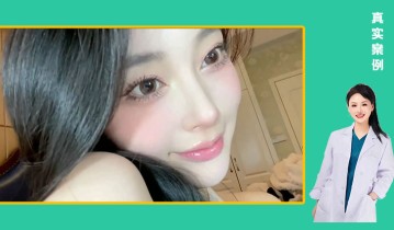 黄金媚眼重睑术效果【2】