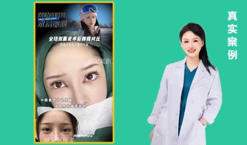 全切双眼皮术后即可对比