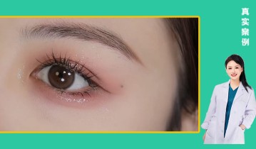 林海青医生-眼综合双眼皮效果