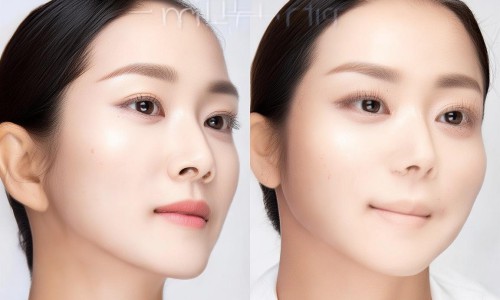 眶隔脂肪释放技术，重塑面部轮廓的新选择